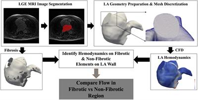 Presence of Left Atrial Fibrosis May Contribute to Aberrant Hemodynamics and Increased Risk of Stroke in Atrial Fibrillation Patients